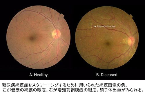 グーグル、人工知能で網膜症を早期発見　医師不足に対策し失明を防止